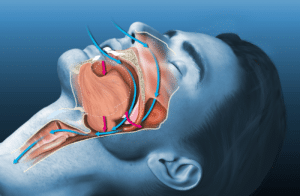 Sleep Apnea ICD 10 code